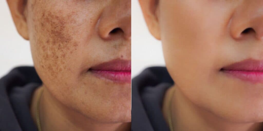 Imune ao melasma: Mulheres ACABAM com manchas escuras no rosto e no corpo com apenas 1 único ingrediente