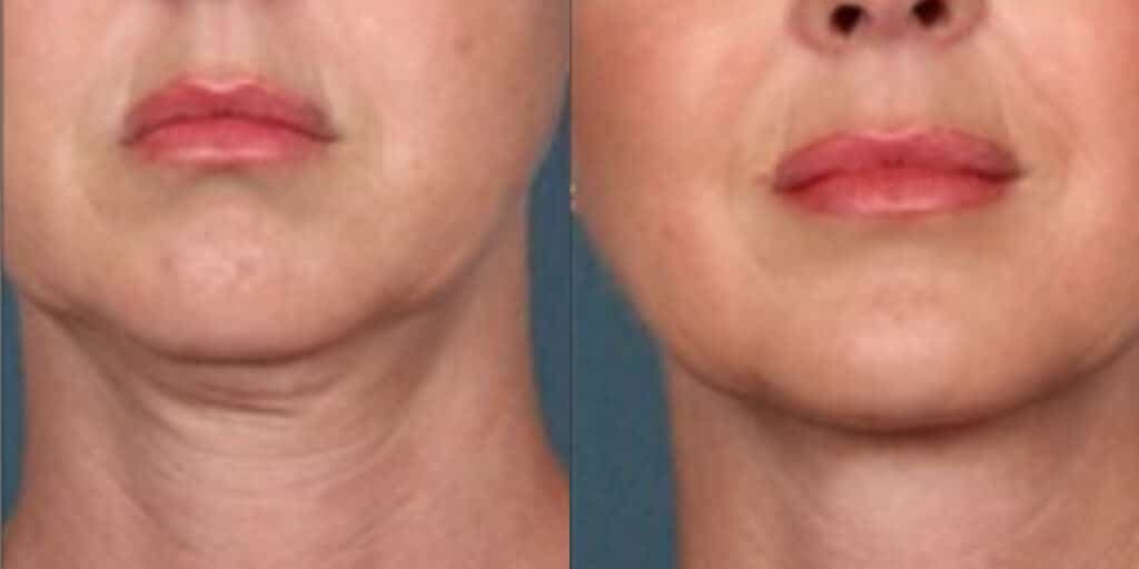 Rosto com Papada antes e depois de exercícios (Foto: Divulgação)