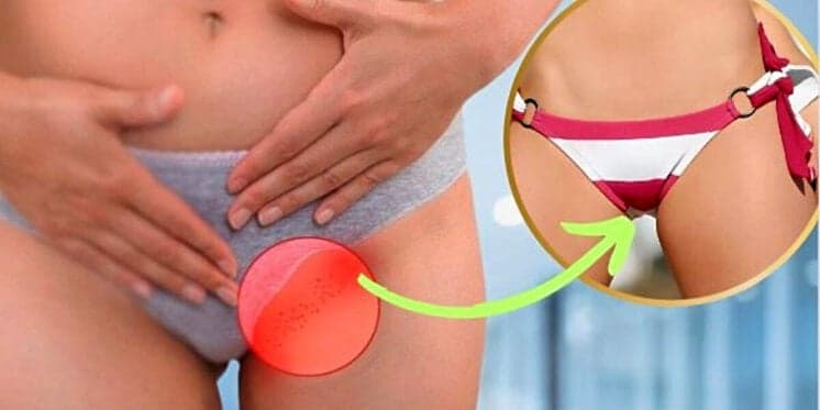 Fim das bolinhas vermelhas e do pelo encravado: 4 segredos para garantir uma pele de bebê logo após se depilar