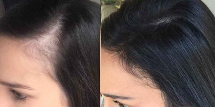 FIM imediato da queda de cabelo: 3 passos infalíveis com alecrim e +3 populares ressuscitam os fios das 60+
