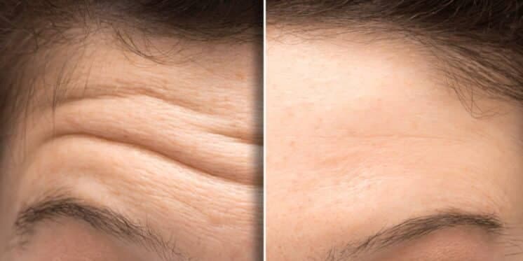 Adeus botox e de graça: Receitinha com mel e +1 ingrediente caseiro dá fim às rugas e manchas em 10 minutos
