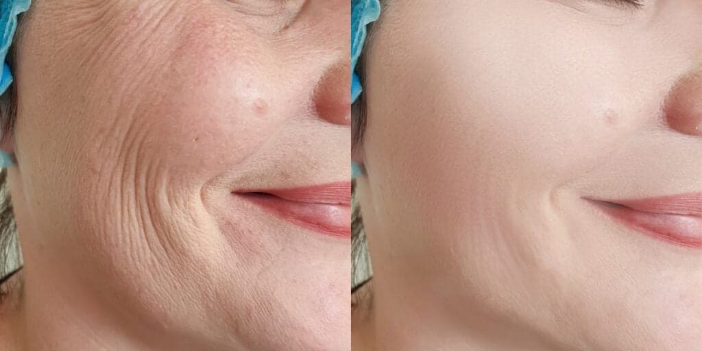 Botox e colágeno aniquilados: Peeling natural com 3 ingredientes suga oleosidade, rugas e manchas em minutos