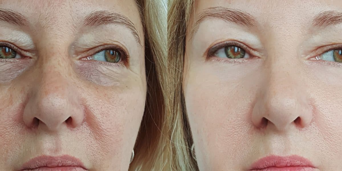 Efeito melhor que botox: Harmonização 100% natural arranca flacidez do rosto e te deixa 30 anos mais nova