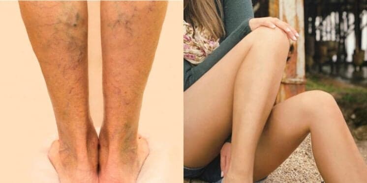 Extermina varizes e manchas: Chá natural com 3 ingredientes deixa perna lisinha em minutos