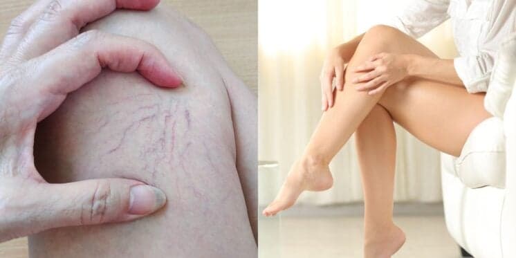 Fim da varizes sem cirurgia: Técnica 100% natural com 1 ingrediente deixa perna das 60+ mais lisas do que porcelana