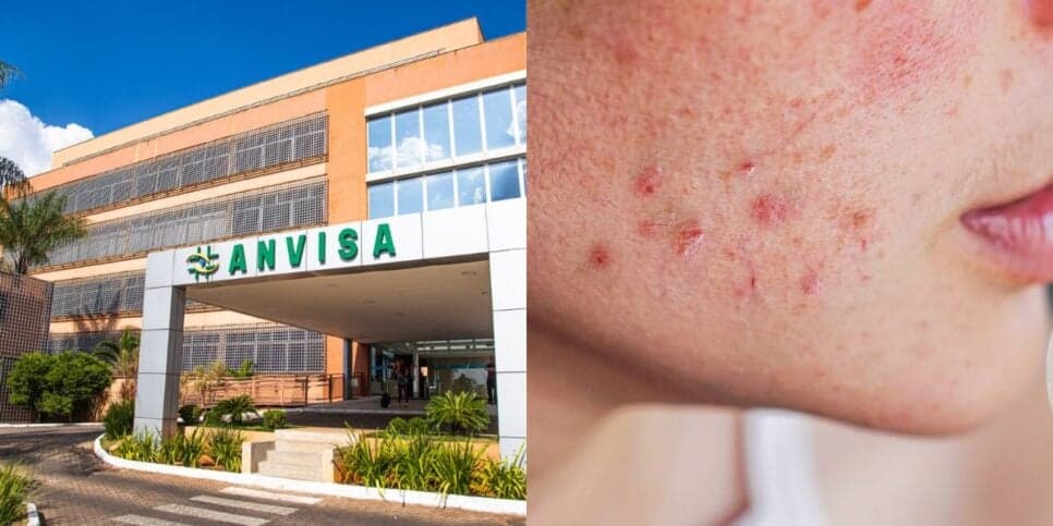 Rosto paralisado e crateras na pele: Nova proibição da ANVISA é confirmada contra 5 queridinhos das mulheres