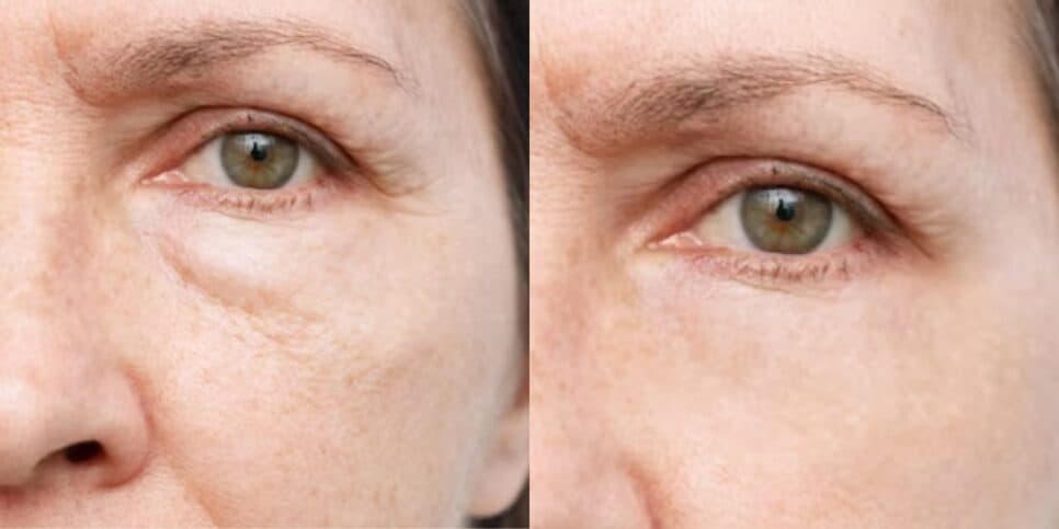 Não gaste com L'Oréal: Botox natural com 4 ingredientes preenche rugas em 5 minutos