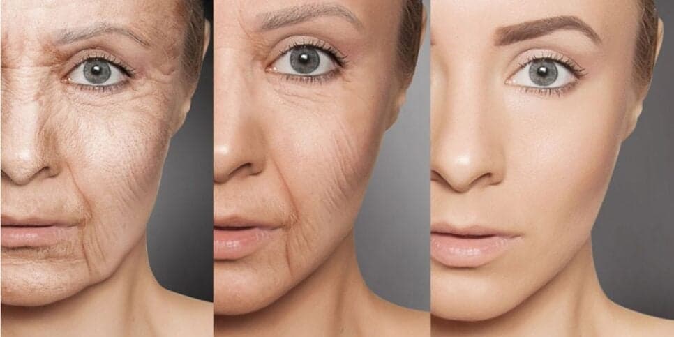 Fim das rugas sem precisar de botox: Receita milagrosa com só 2 ingredientes para uma pele de porcelana