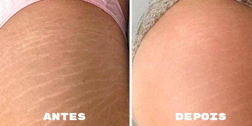Segredo das famosas revelado: Receitinha com apenas 2 ingredientes caseiros elimina estrias em 10 minutos