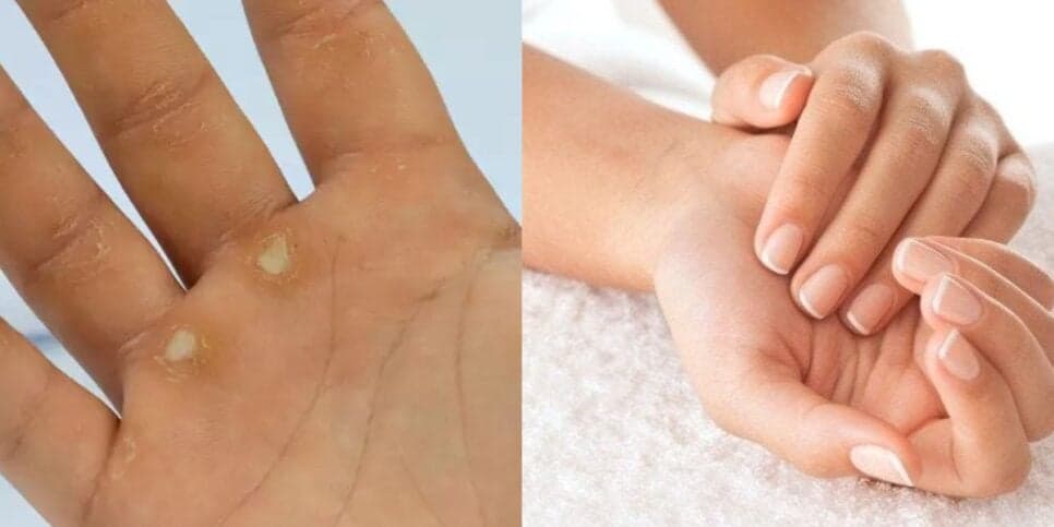 Mãos ressecadas / Mãos hidratadas - Montagem TVFOCO