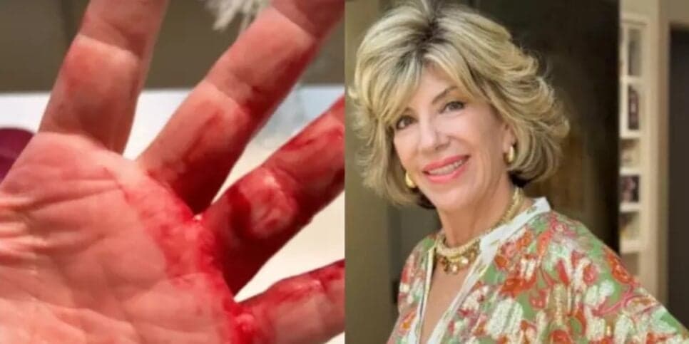 Silvia Poppovic sofre assalto violento em São Paulo e surge ensanguentada: "Quase arrancaram minhas mãos''