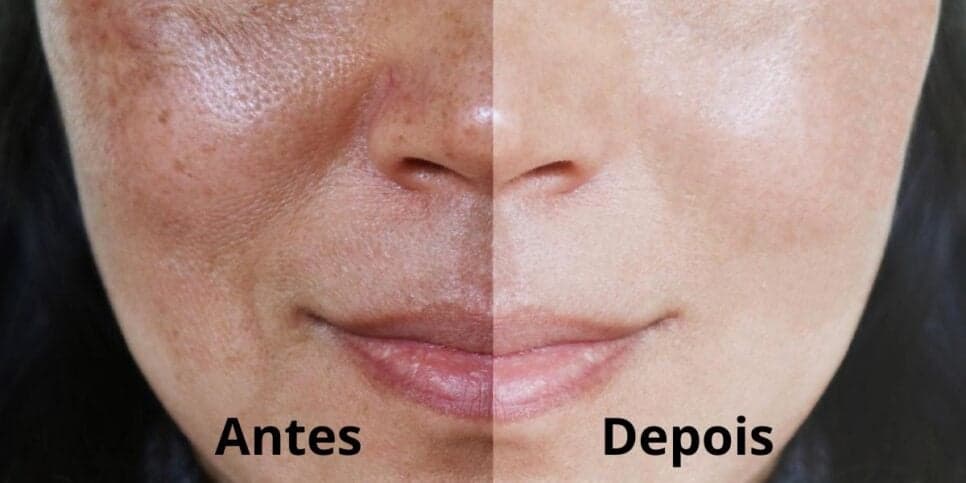 Manchas escuras aniquiladas e rejuvenesce na hora: Peeling natural está salvando a pele das mulheres em 4 passos