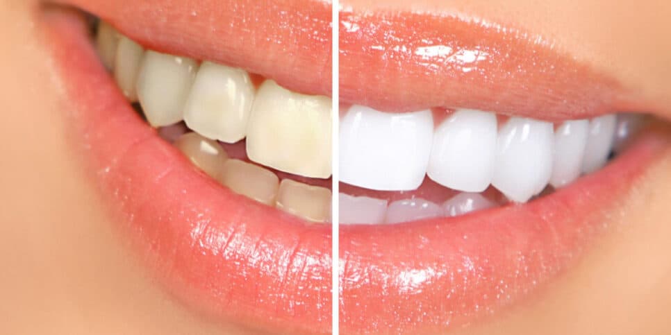 Fim do bafo, dente amarelo e +: Único ingrediente que você tem em casa garante sorriso matador em 10 minutos