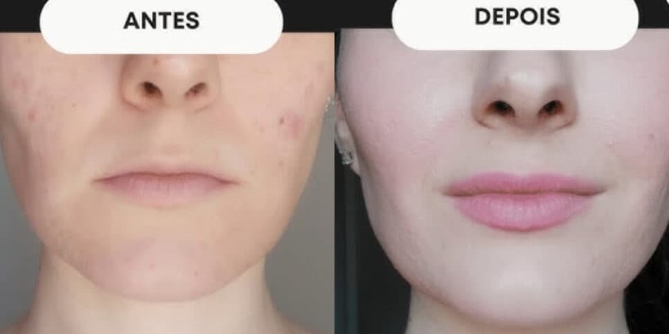 Fim do botox: Harmonização facial caseira rejuvenesce 10 anos em 15 minutos sem gastar nem 1 real