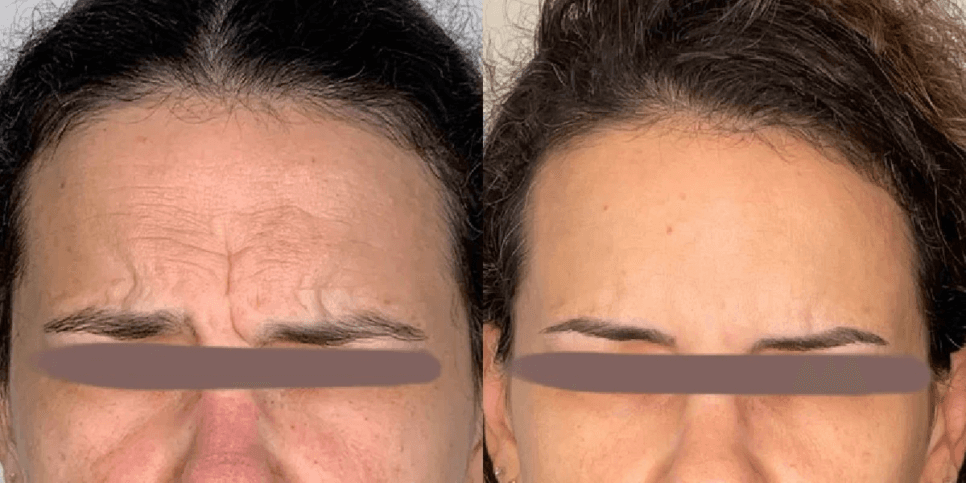 Antes e depois do botox - foto: TV Foco