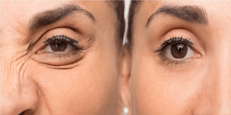Antes e depois do botox - foto: TV Foco