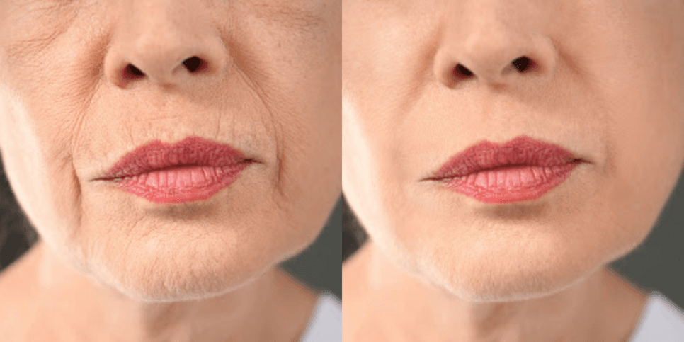 Antes e depois após bioestimulação de colágeno - foto: TV Foco Antes e depois após bioestimulação de colágeno - foto: TV Foco