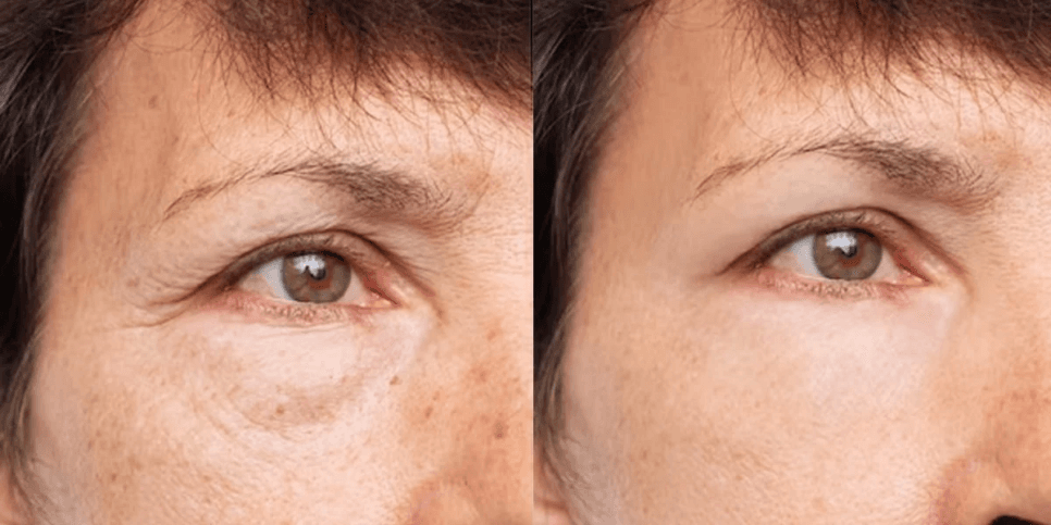 Antes e depois após botox - foto: TV Foco