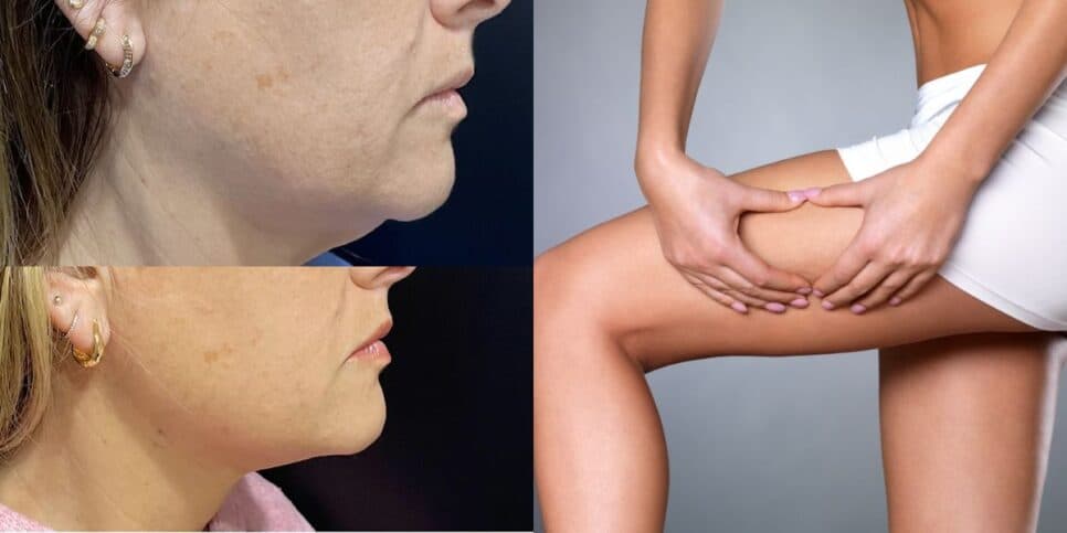 Adeus papada e pernas moles: 5 receitinhas caseiras acabam com a flacidez das mulheres de forma imediata
