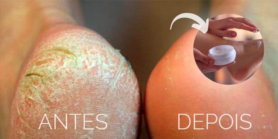 Fim das rachaduras e calos: Receita caseira hidrata e deixa seus pés como um algodão em apenas 3 passos
