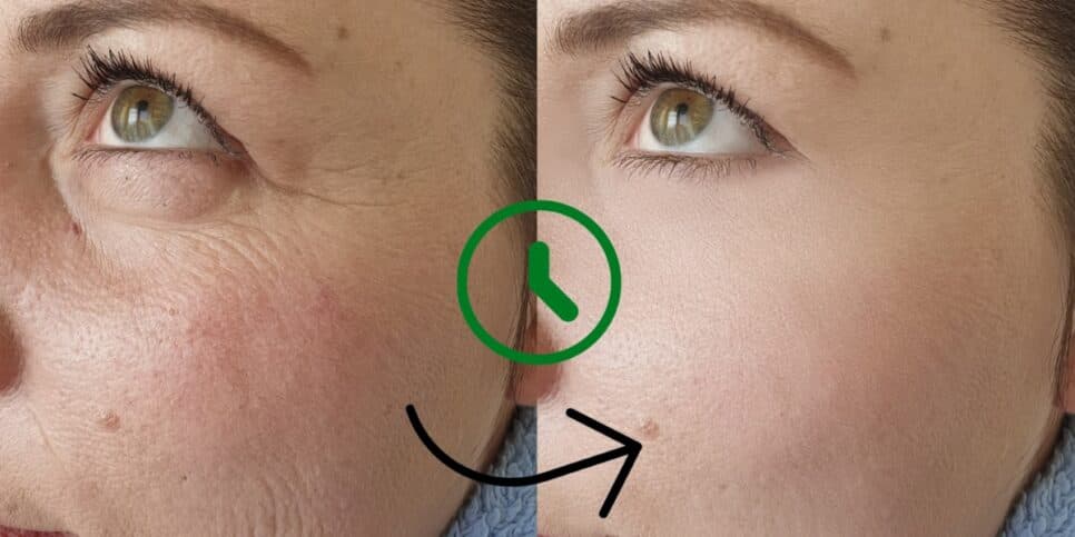 Adeus Botox: Harmonização caseira transforma o rosto em 15 minutos e está deixando senhoras livres de rugas