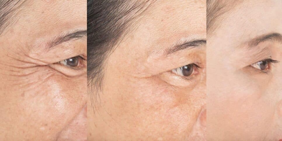 Paralisa o envelhecimento: Botox natural com 4 ingredientes suga rugas e traz pele de seda às 50+