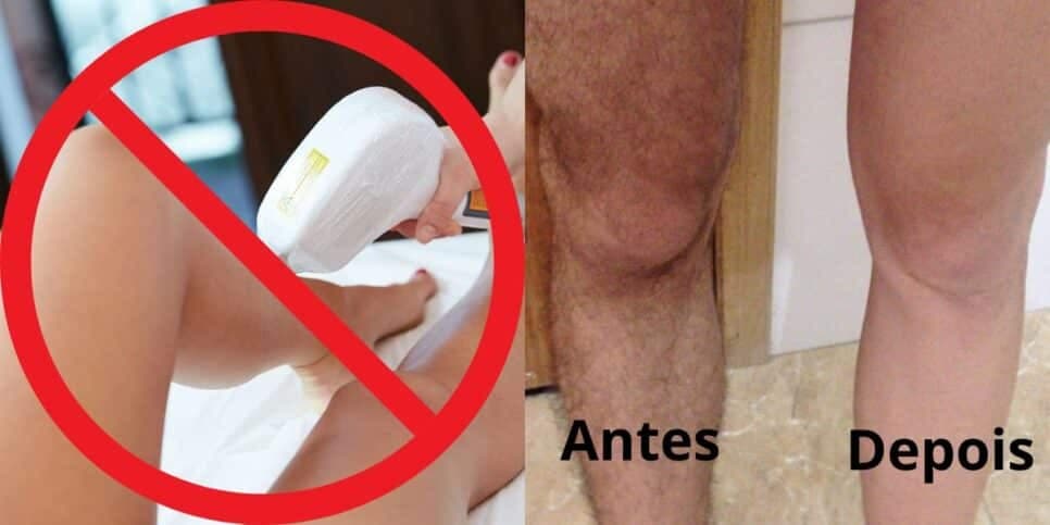 Fim da depilação à laser: Misturinha com maracujá e +1 item pra acabar com os pelos e ter pele de bebê