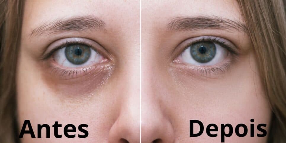 Adeus manchas mesmo dormindo pouco: 1 único ingrediente extermina as olheiras dos olhos das 40+