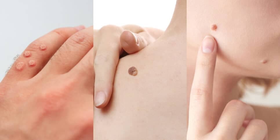 Fim das verrugas sem cirurgia: 6 receitinhas caseiras dão fim à lesão em qualquer parte do corpo em 5 minutos
