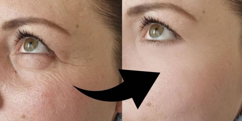 Fim das rugas e pele de 20 anos: Botox natural com 3 ingredientes paralisa o envelhecimento em 15 minutos