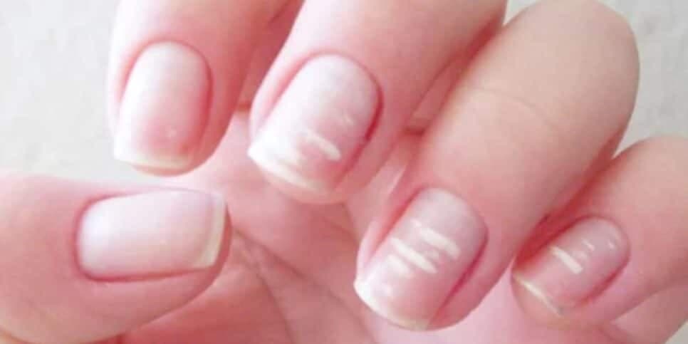 Unhas frágeis e esbranquiçadas (Reprodução/Internet)
