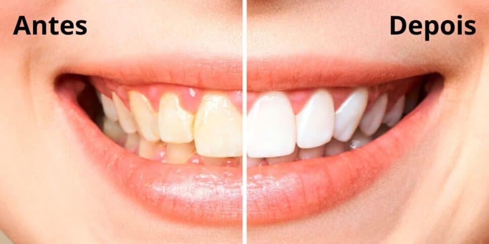 Fim do tártaro e cor amarela: Receitinha caseira com 3 ingredientes deixa os dentes brancos sem gastar 1 real