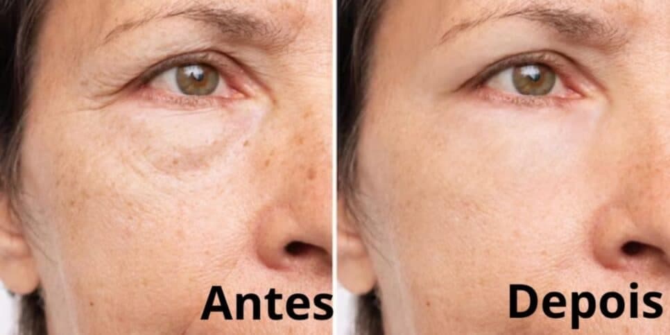 Fim das rugas e resultado imediato: Harmonização facial caseira com único ingrediente traz pele de porcelana
