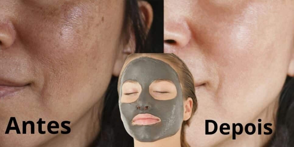 Fim das manchas escuras e melasma: Receita caseira com argila clareia a pele e você dará adeus ao laser