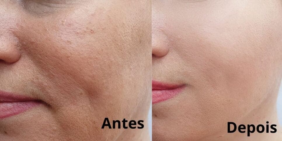Adeus às rugas e anos mais jovem: Harmonização facial caseira traz pele de bebê em apenas 3 passos