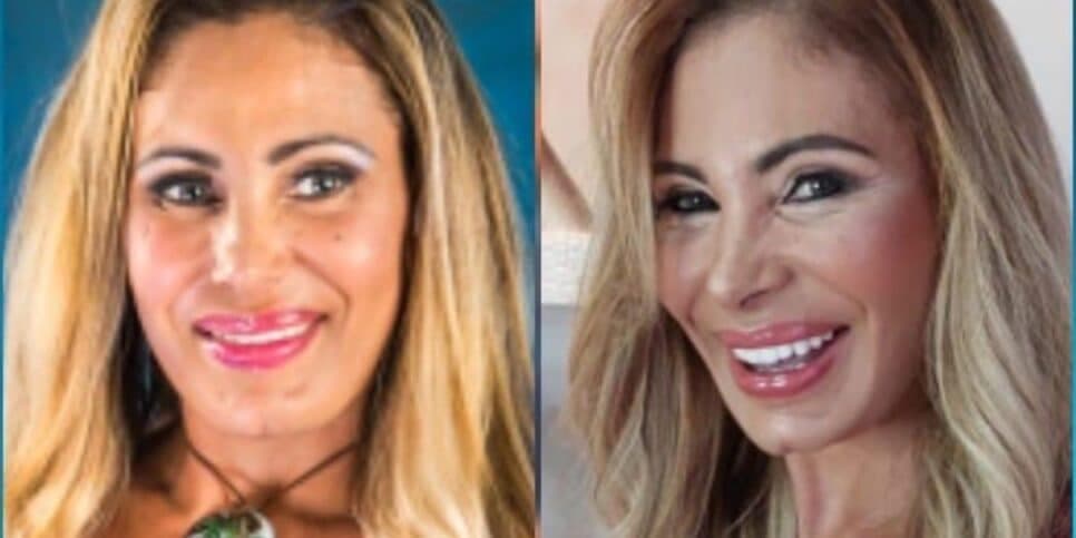 Ângela Bismarchi realiza procedimento de Lift Facial