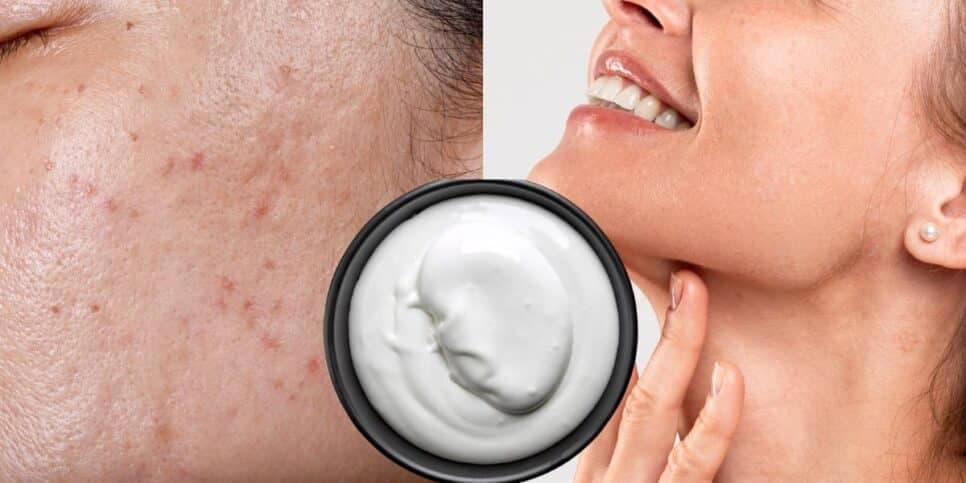 Fim das rugas, oleosidade e cravos: Botox caseiro com 2 ingredientes traz pele de porcelana em 30 minutos
