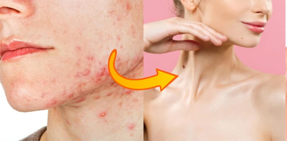 Adeus acne e rosto manchado: Único ingrediente elimina espinhas e traz pele das japonesas às 50+