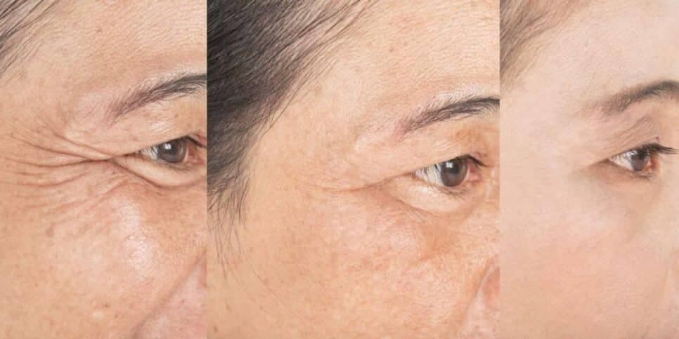 Pele de porcelana: Botox caseiro com 3 ingredientes traz melhor colágeno do mundo para sugar as rugas