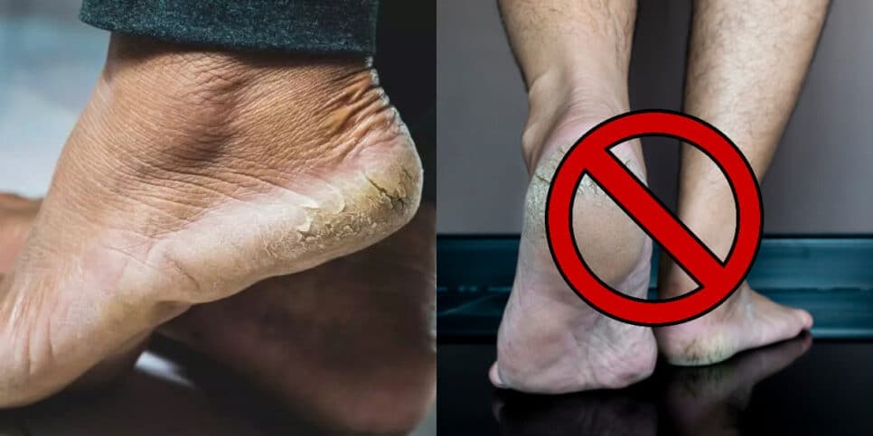 Adeus pés rachados e incômodo: Único ingrediente com acaba com pesadelo e te deixa com pés de bebê