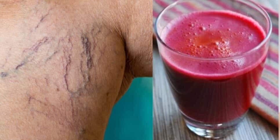 O suco milagroso com único ingrediente popular que suga varizes das 55+ e dá fim ao terror após menopausa