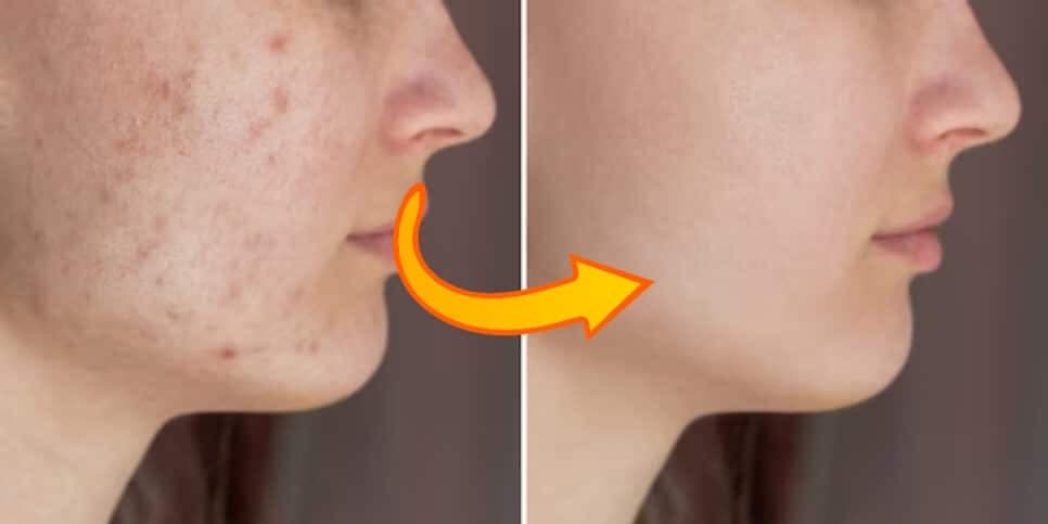 FIM das espinhas: Pele invejável com mistura com 2 ingredientes