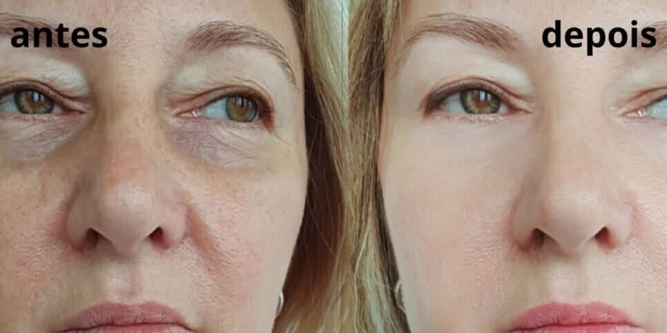 Tchau, rugas: Único ingrediente natural e que você tem em casa, traz pele de bebê às mulheres 50+