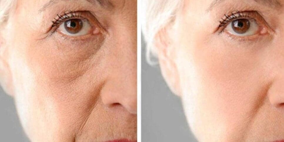 FIM do botox: Harmonização caseira transforma o rosto em 15 minutos e rejuvenesce idosas 20 anos