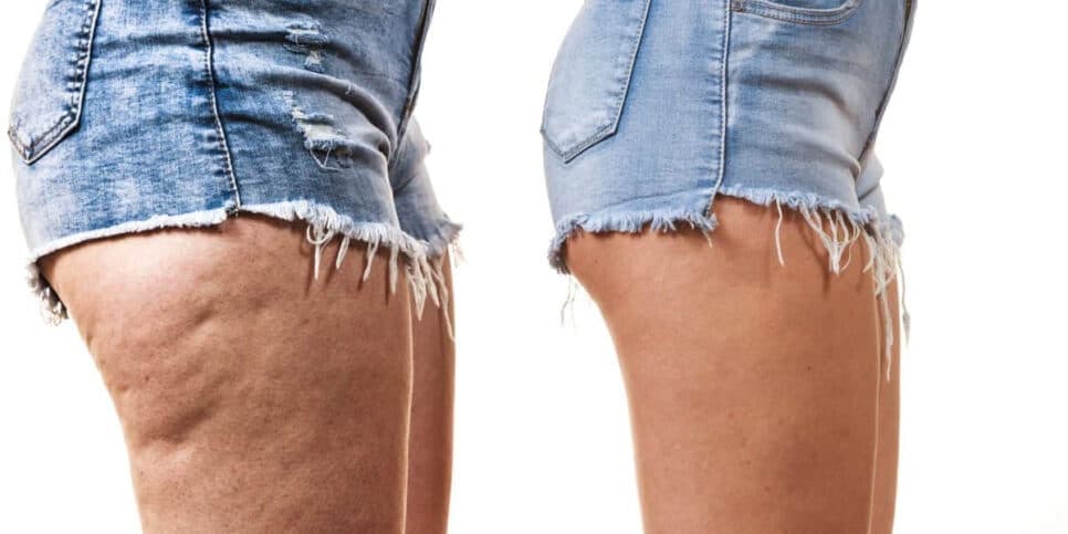 Fim da celulite e incômodo: Único ingrediente infalível elimina problema das 40+ em 15 minutos