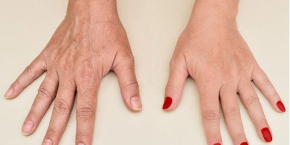 Mão enrugada nunca mais: Colágeno puro com ingrediente caseiro rejuvenesce em segundos