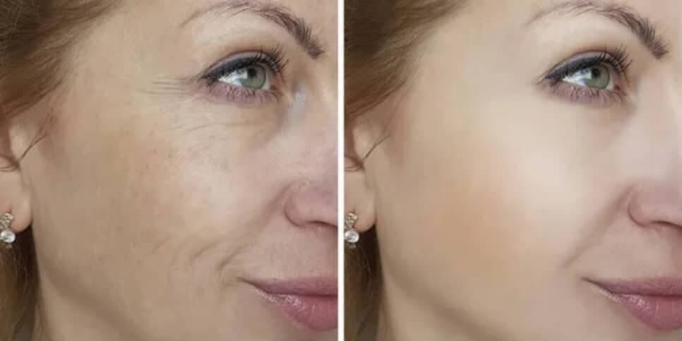 Antirrugas mais potente do mundo: Elimina às rugas das 50+ em 20 minutos