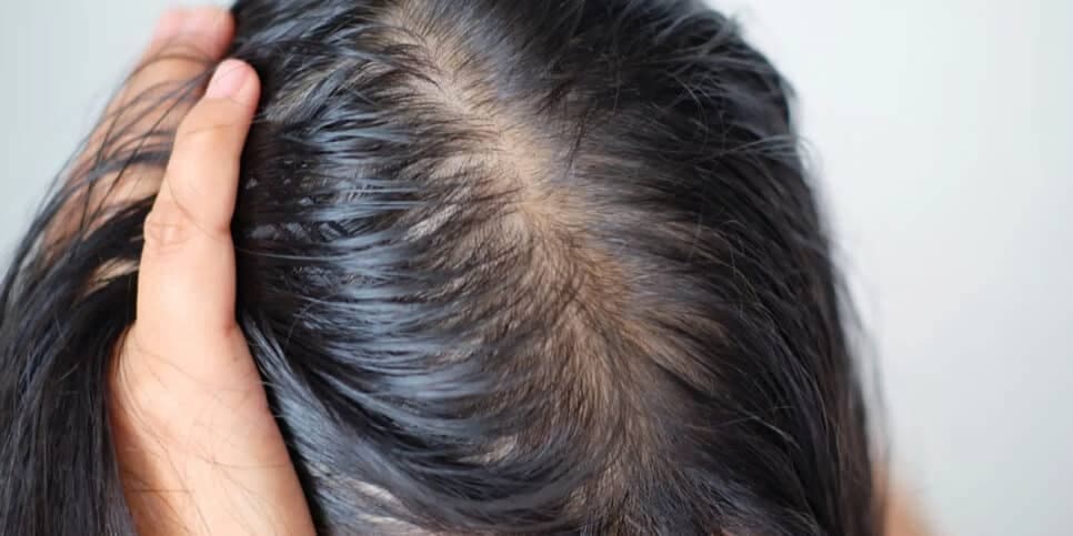 5 receitas caseiras para dar FIM na oleosidade e ressuscitar o seu cabelo em outubro