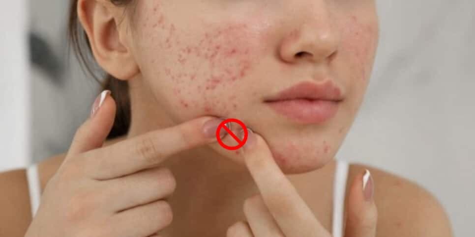 Tchau, espinhas e cravos: Único ingrediente elimina acne e traz pele das japonesas às 50+