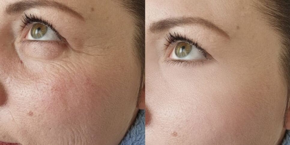Falência das clínicas de estética: Ácido hialurônico caseiro com 5 ingredientes suga rugas das 60+